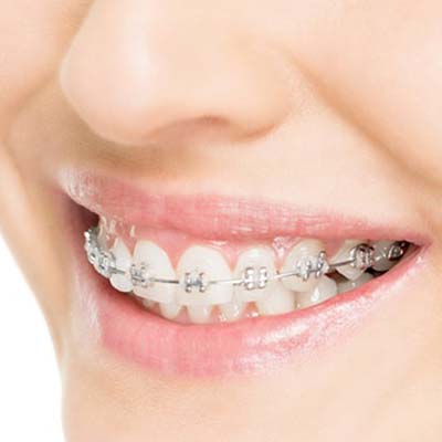 Invisalign ZÃ¼rich