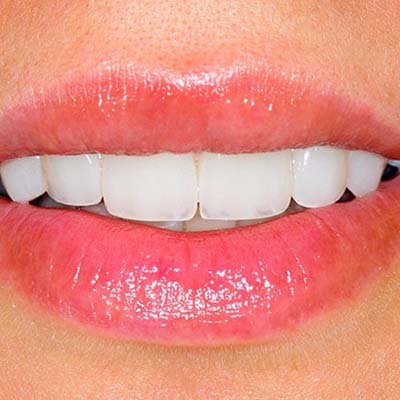 Schöne Zähne mit Keramikplättchen (Veneers)