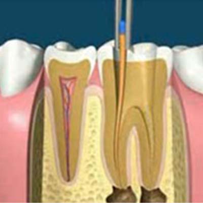 Querschnitt von einem Zahn bei einer Wurzelbehandlung